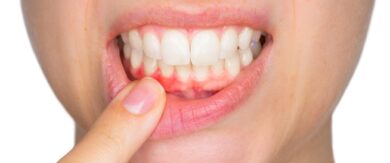 علامات أمراض اللثة