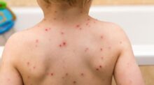 الأمم المتحدة تحذر من تفشي واسع لجدري الماء بين النازحين في قطاع غزة