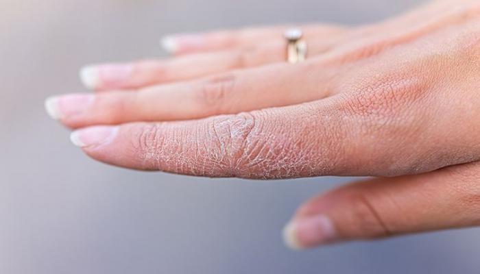 أعراض نقص الزنك.. 10 علامات تظهر على الجسم